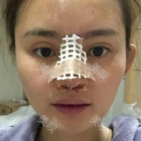 玻尿酸隆鼻花了兩萬(wàn)多果很自然哦，值~！