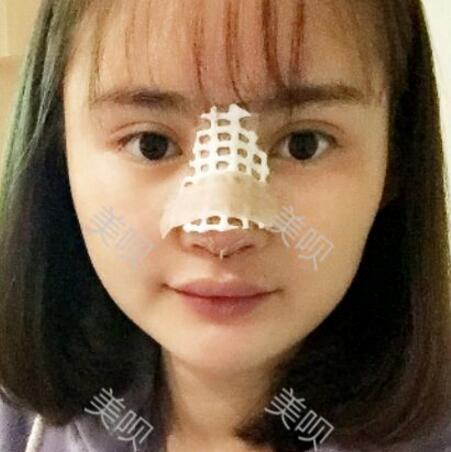 玻尿酸隆鼻花了兩萬(wàn)多果很自然哦，值~！