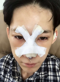 深圳廣和尹衛(wèi)民做的隆鼻整形，大家來(lái)看看果
