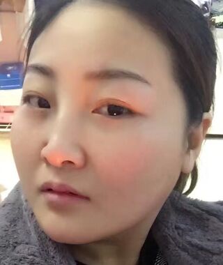 金子甘國端醫(yī)生給我做完高強(qiáng)度聚焦超聲之后皮膚緊致多了