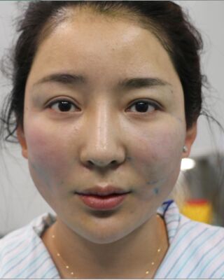 埋埋蛋白線.提升整個(gè)面部年輕很多，小V臉也出來了