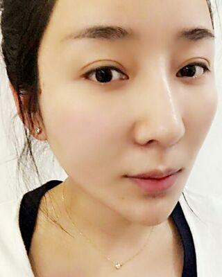 埋埋蛋白線.提升整個(gè)面部年輕很多，小V臉也出來了