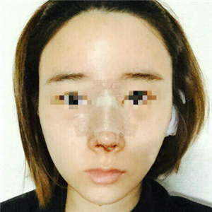 蔣醫(yī)生做的隆鼻失敗修復(fù)分享，還有前后對(duì)比果圖片哦~