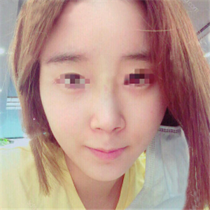 蔣醫(yī)生做的隆鼻失敗修復(fù)分享，還有前后對(duì)比果圖片哦~