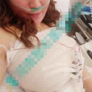 分享我自體脂肪隆胸手術(shù)前后對比照片，果不錯哦~