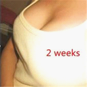 分享我自體脂肪隆胸手術(shù)前后對比照片，果不錯哦~