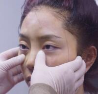 自體脂肪隆鼻、墊下巴、豐蘋果肌前后對比圖和恢復過程分享