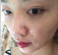 自體脂肪隆鼻、墊下巴、豐蘋果肌前后對比圖和恢復過程分享