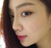 自體脂肪隆鼻、墊下巴、豐蘋果肌前后對比圖和恢復過程分享