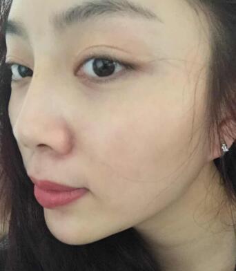 自體脂肪填充面部術(shù)后圖片分享