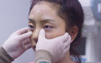 自體脂肪面部填充術(shù)前檢查