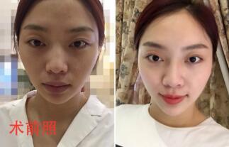 自體脂肪面部填充前術(shù)后對(duì)比照