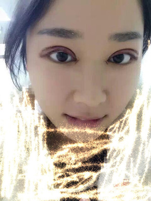 你們來(lái)看看翟爽做的切開(kāi)雙眼皮怎么樣