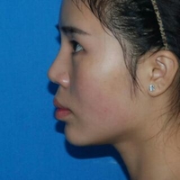 隆鼻失敗修復(fù)后果自然宛若天生