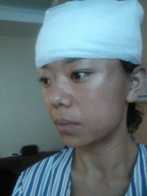 電波l皮緊膚手術過程及前后對比照片