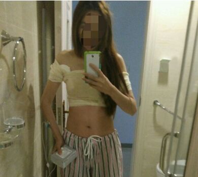 完全平胸的我做了假體隆胸之后終于有胸了