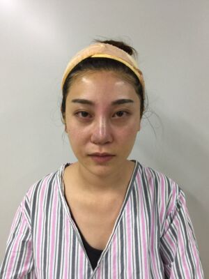 不想再打玻尿酸就去做了硅膠假體隆鼻