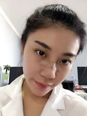 不想再打玻尿酸就去做了硅膠假體隆鼻