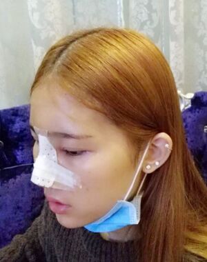 隆鼻整形果好到無法形容，廣州海峽軍做的