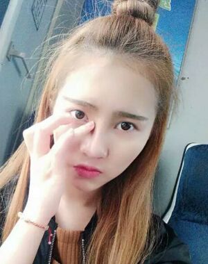 隆鼻整形果好到無法形容，廣州海峽軍做的