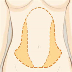 京韓做腰腹吸脂四個(gè)月的恢復(fù)照片，喬愛(ài)軍醫(yī)生的技術(shù)很好哦~