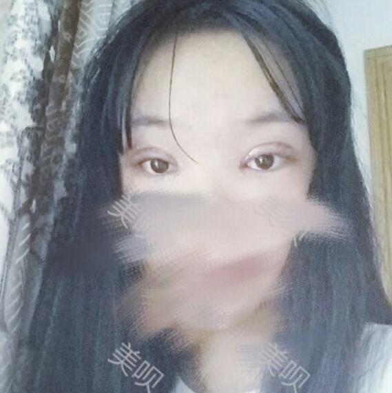 給大家分享下我割雙眼皮的恢復全過程希望對大家有幫助