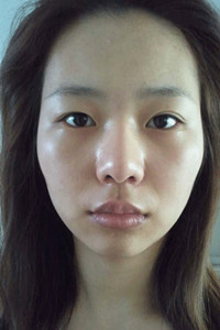 磨骨+下巴矯正手術(shù)前后過(guò)程(膽小勿入!)真實(shí)案例分享