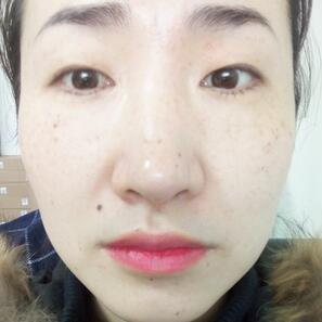 激光祛斑20天后的圖片 北京歐華王芳