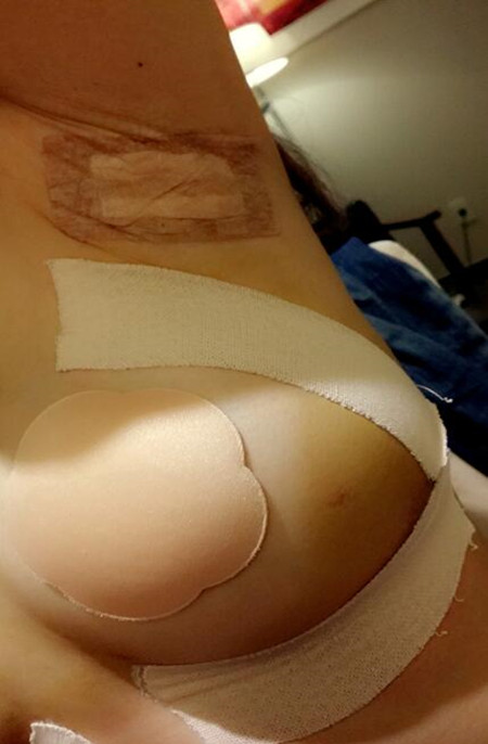 小胸和大胸就差一個(gè)李鴻君做的假體隆胸手術(shù)