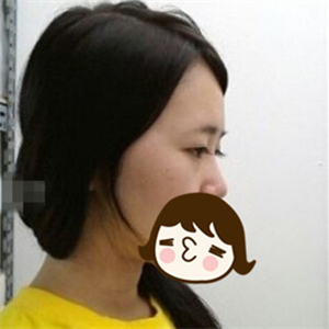 去年做的自體脂肪隆鼻手術(shù)，曬一下前后對比果圖片~