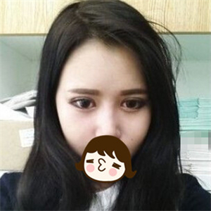 去年做的自體脂肪隆鼻手術(shù)，曬一下前后對比果圖片~