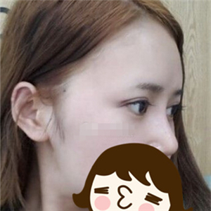 去年做的自體脂肪隆鼻手術(shù)，曬一下前后對比果圖片~