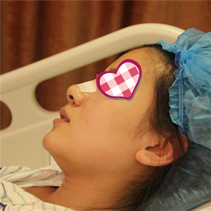 分享我自體軟骨隆鼻前后對比果圖片和恢復(fù)過程，在愛斯克做的哦~