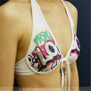 自體脂肪移植隆胸三個(gè)月了，分享恢復(fù)前后對(duì)比果照片~