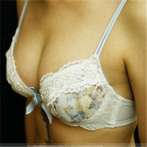 自體脂肪移植隆胸三個(gè)月了，分享恢復(fù)前后對(duì)比果照片~