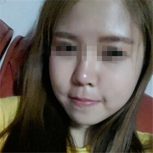 去年做了玻尿酸填充去法令紋，有前后對(duì)比果圖片哦~