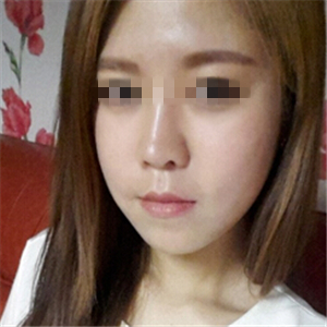 去年做了玻尿酸填充去法令紋，有前后對(duì)比果圖片哦~