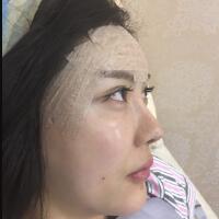 自體脂肪面部填充——豐太陽(yáng)穴豐額頭恢復(fù)過程真實(shí)案例分享