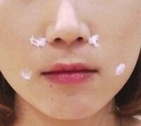 注射玻尿酸除皺價(jià)格3600元，術(shù)后果分享