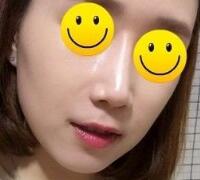 注射玻尿酸除皺價(jià)格3600元，術(shù)后果分享