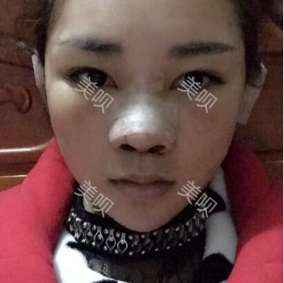 給大家分享在長(zhǎng)沙鵬愛做的膨體隆鼻近一個(gè)月的恢復(fù)過(guò)程