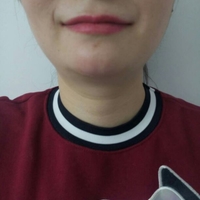 玻尿酸墊下巴后改變了我的大餅?zāi)樄镣淄椎? /> </a>
<a href=