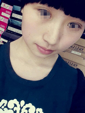 做了切開(kāi)雙眼皮手術(shù)，現(xiàn)在恢復(fù)的還不錯(cuò)哦