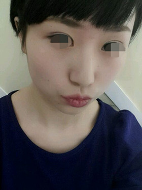 做了切開(kāi)雙眼皮手術(shù)，現(xiàn)在恢復(fù)的還不錯(cuò)哦