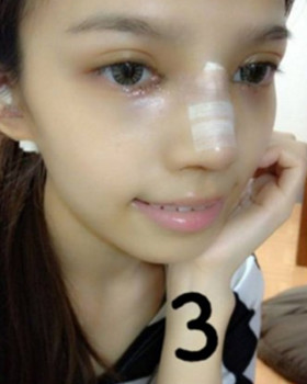 記錄了隆鼻三個(gè)月前后的恢復(fù)過(guò)程，希望可以幫到有需要的朋友