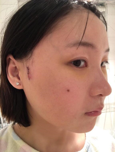 磨下頜角加顴弓截骨降低讓我擁有女神高顏值