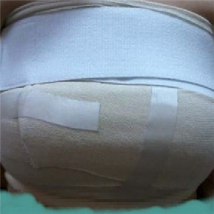 自體脂肪隆胸四個月了，曬一下恢復過程和前后對比果圖片~