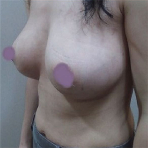 自體脂肪隆胸四個月了，曬一下恢復過程和前后對比果圖片~