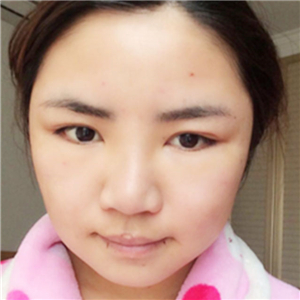 磨骨磨下頜角半年了，分享恢復過程和前后對比果照片哦~