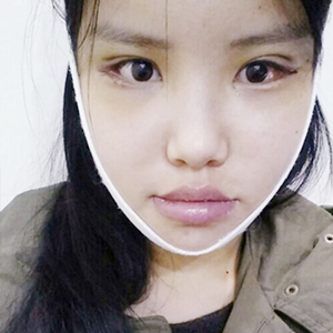 做下頜角整形手術(shù)半年了，給你們看看恢復過程照片吧~